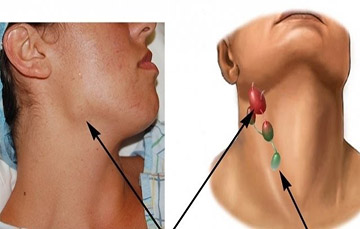 Почему воспалился лимфоузел на шее: причины и лечение